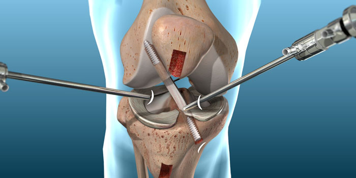 ACL Reconstruction