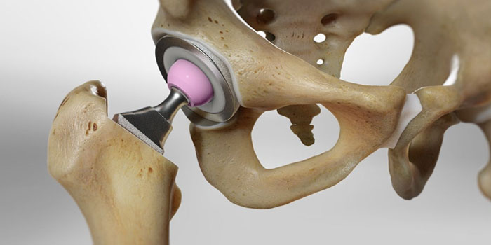 Reverse Shoulder Replacement