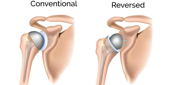 Reverse Shoulder Replacement
