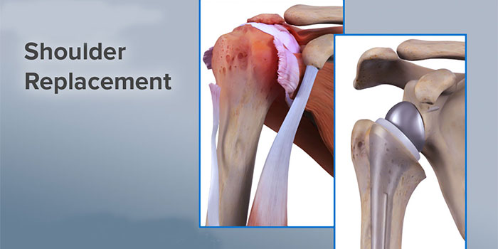 Total Shoulder Replacement