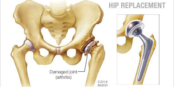 Total Hip Replacement