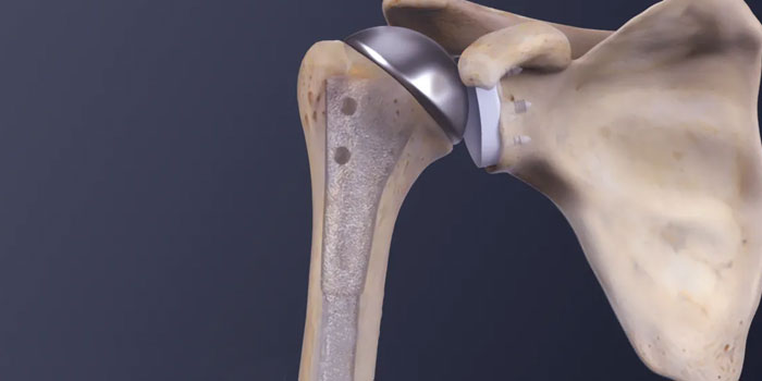 Shoulder Replacement