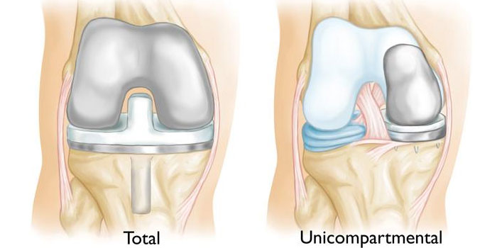 Reverse Shoulder Replacement
